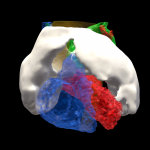 Toronto Heart Atlascardiac tumor
Cardiac CT. Rendering on Sketchfab.