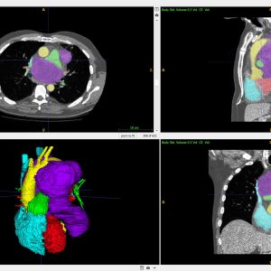 Digial Modeling of Cardiac Tumor from CT
Segmentation of tumor and blood pools
ITK-Snap
