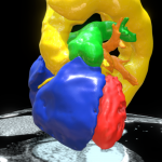 Interactive rendering Toronto Heart Atlas Normal Morphology; Type-A Aortic Dissection